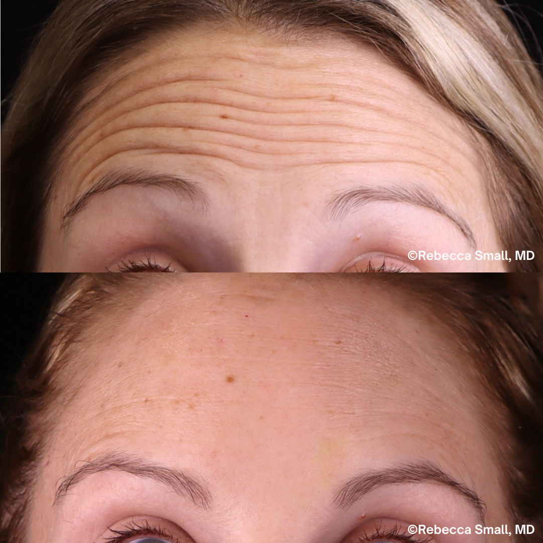 Forehead Lines