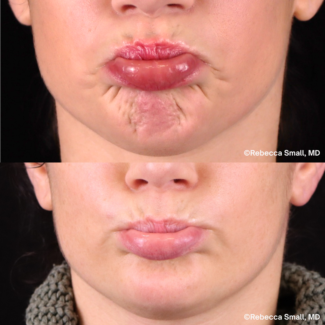 Chin Lines