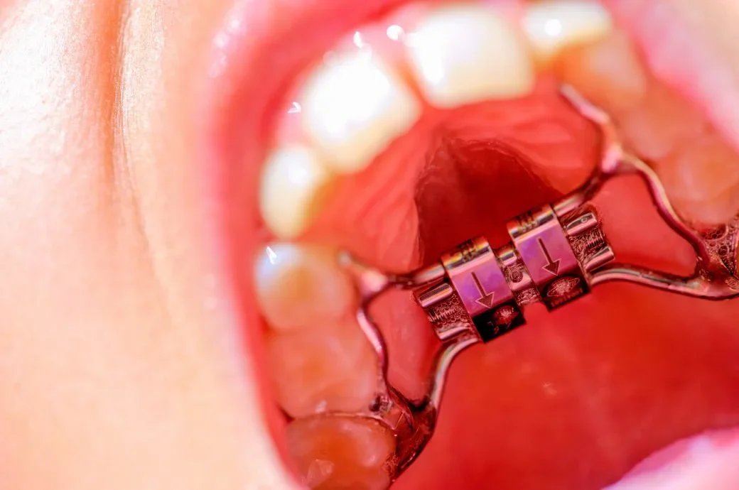 Close-up of a child’s mouth with a palatal expander orthodontic appliance attached to the upper teeth