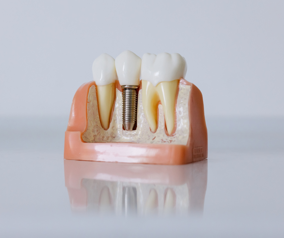 Dental implant model showing an artificial tooth attached to an implant post
