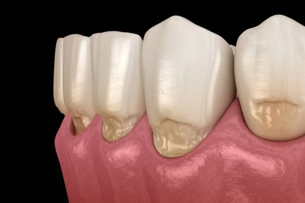 3D illustration showing abfraction notches at the gumline caused by tooth grinding