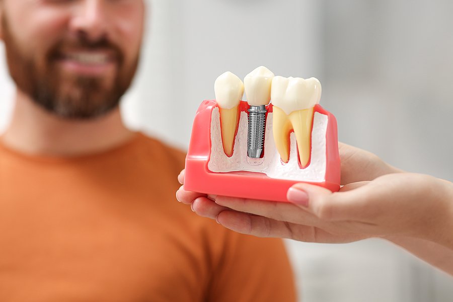 Person holding a dental implant model to highlight the importance of replacing missing teeth for oral health and function.