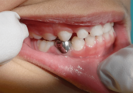 Close-up of a child’s molar with a stainless steel dental crown placed by a pediatric dentist