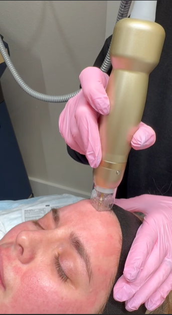 A person lying down with eyes closed during a cosmetic procedure, receiving treatment with a large gold-colored device held by someone wearing pink gloves.