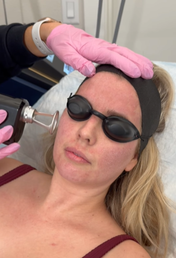 A woman receiving a cosmetic treatment on her forehead in a medical setting. She is lying down, wearing protective goggles, and a medical professional is using a device on her skin with a gloved hand gently resting on her forehead.