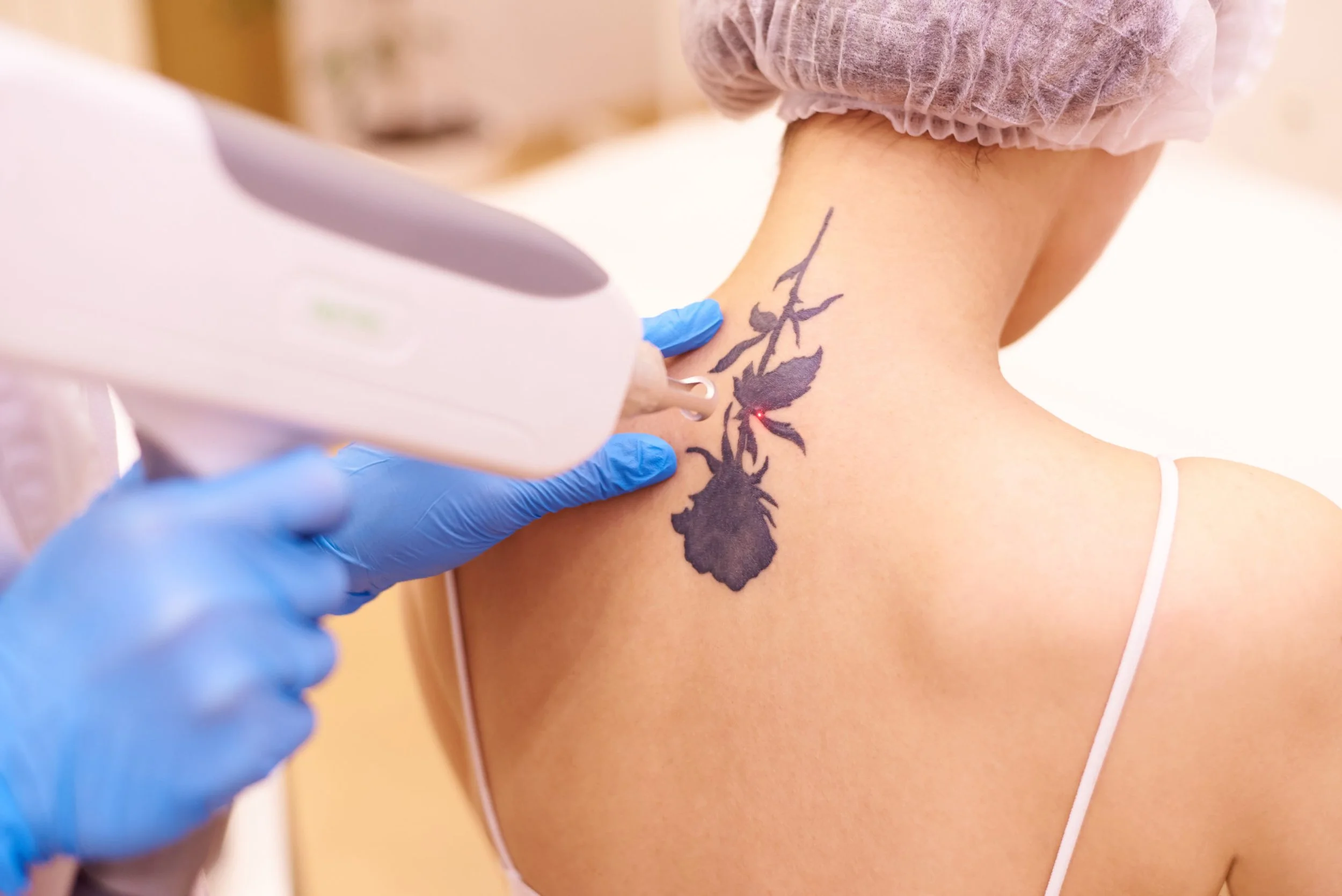 A person getting a tattoo on the back of their neck using a laser tattoo removal device.
