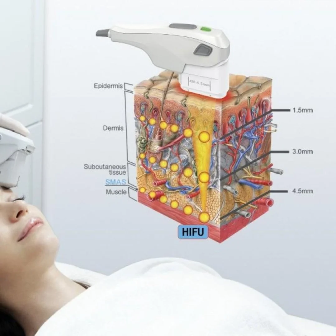 Illustration of skin layers showing how High-Intensity Focused Ultrasound (HIFU) targets different depths for skin treatment.