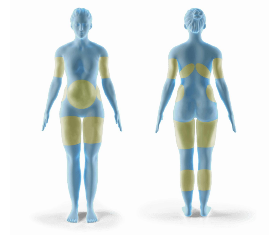 A female model with colored regions indicating common areas of pain or sensitivity for different medical conditions, viewed from front and back.