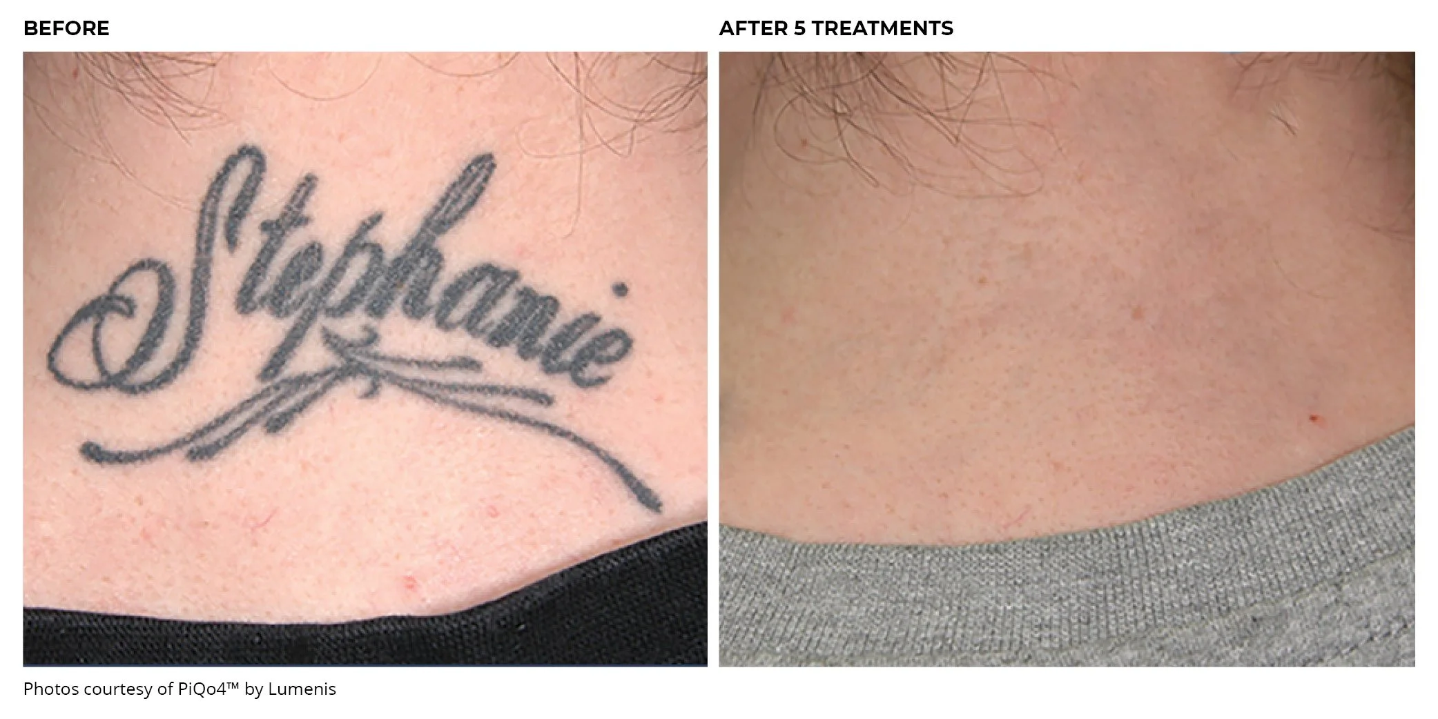 Comparison of a person's skin before and after five treatments; the person has a tattoo that says 'Stefanie' in the first image, which is not visible in the second.