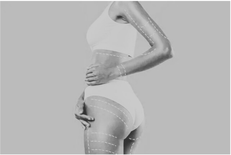 A woman in a sports bra and underwear with dashed lines indicating areas where liposuction or body contouring procedures might be performed, including the waist, arm, thigh, and hip.