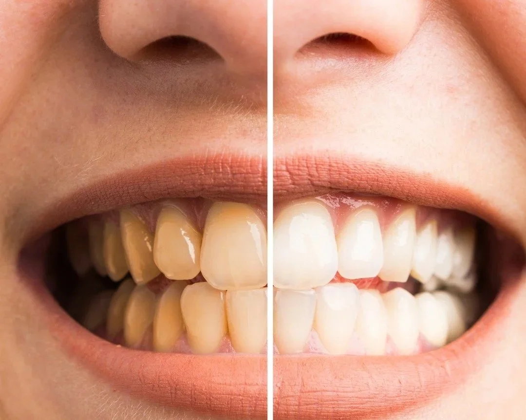Close-up of a person's smile showing before and after teeth whitening, with the left side displaying yellow teeth and the right side showing whiter teeth.