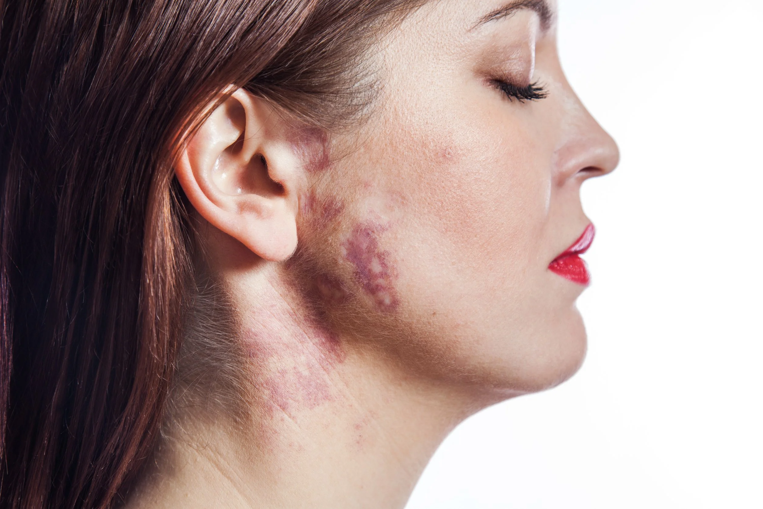 Close-up of a woman's face showing scars and discoloration from a skin condition on her cheek, jawline, and neck.