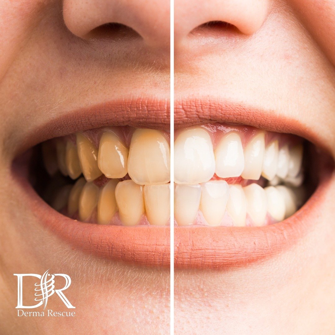 Close-up of a smiling person's mouth showing teeth before and after teeth whitening or dental treatment, with the left side displaying yellow teeth and the right side showing whiter teeth.