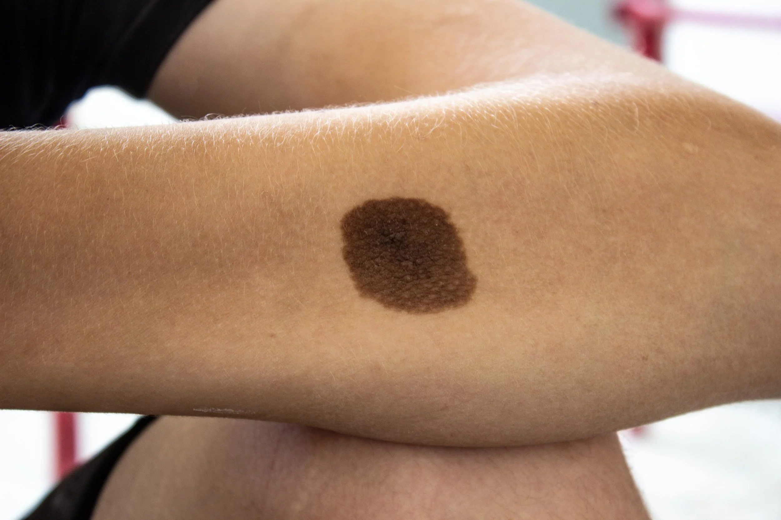 Close-up of a person's arm with a large, dark brown mole.
