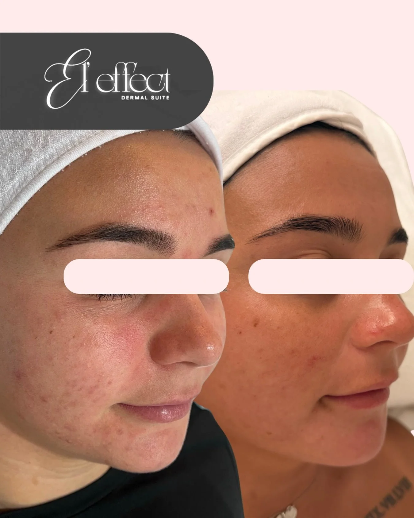 Saturday skin progress appreciation 💗

My patient has been undergoing a tailored plan from the initial consultation, presenting with barrier impairment and atopic concerns.

We developed an appropriate skin care regime to support the skin, alongside