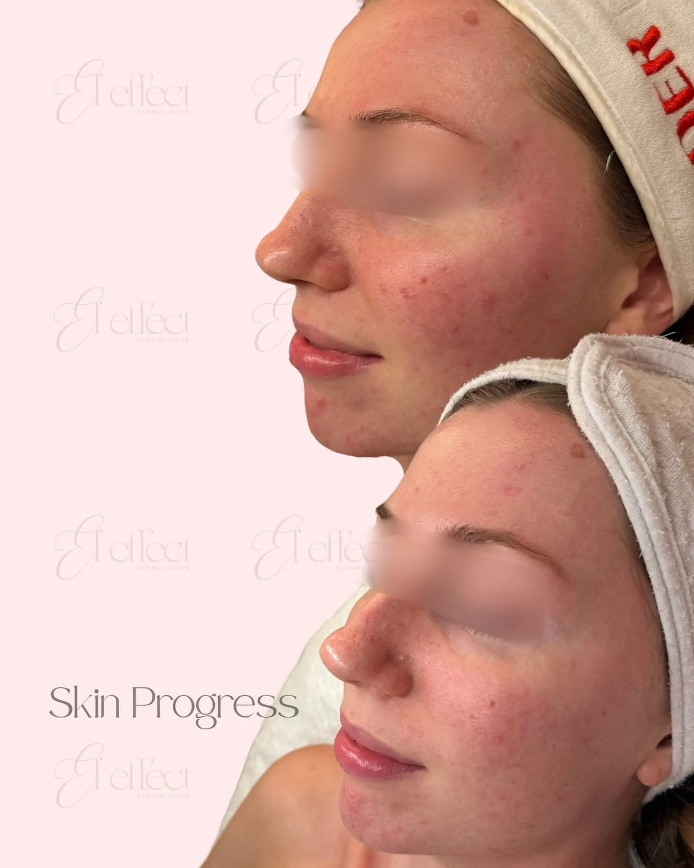 My favourite part of looking after your skin is celebrating all the wins, big and small, when it comes to your skin progress. Pictured is exciting skin progress within one-month, what did we do?

💗 Tailored Dermal Clinician Consultation &amp; Plan w