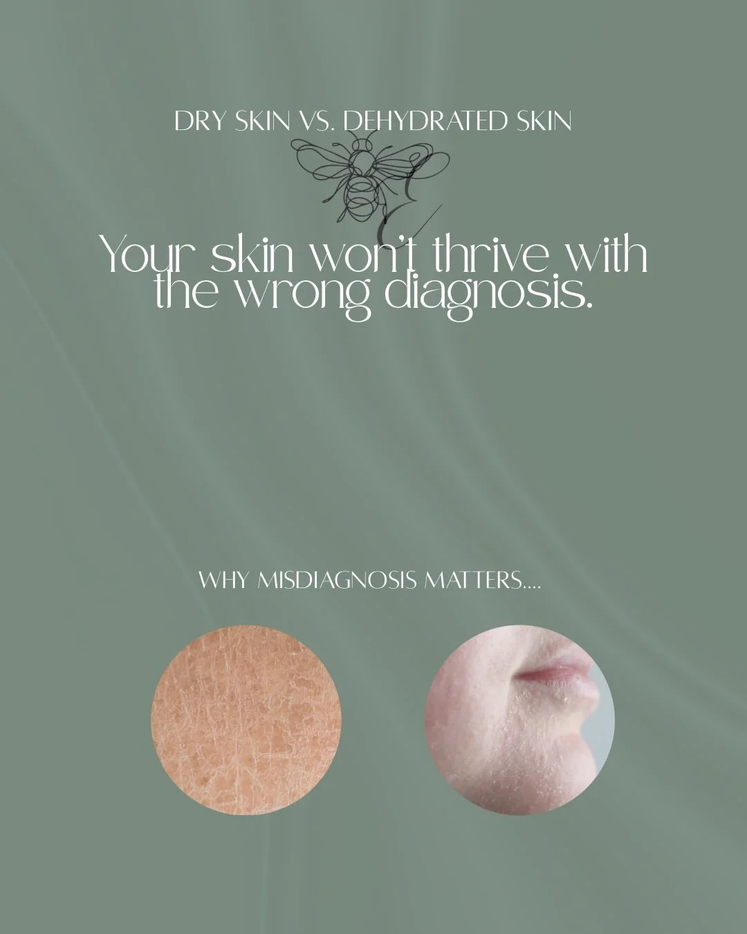 Do you actually have dry skin&hellip; or is your skin dehydrated?

This is one of the most common misdiagnoses we see in clinic&hellip; especially within oily, combination &amp; acne-prone skin types.

Many people are treating dehydration as &ldquo;d