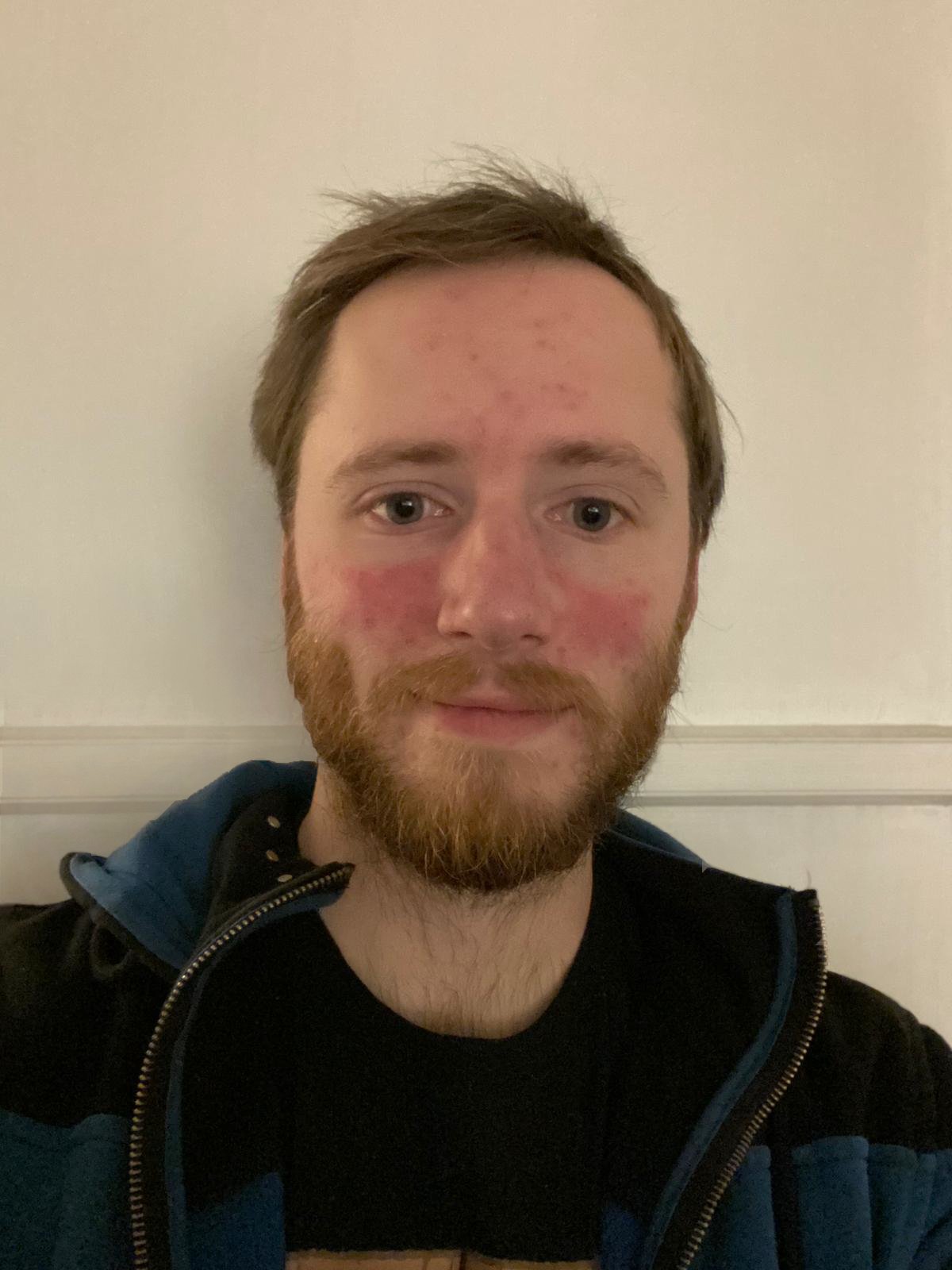 A young man with fair skin, a beard, and short brown hair, appears to have a facial rash and redness on his cheeks and nose, wearing a black shirt with a blue jacket, standing against a light-colored wall.