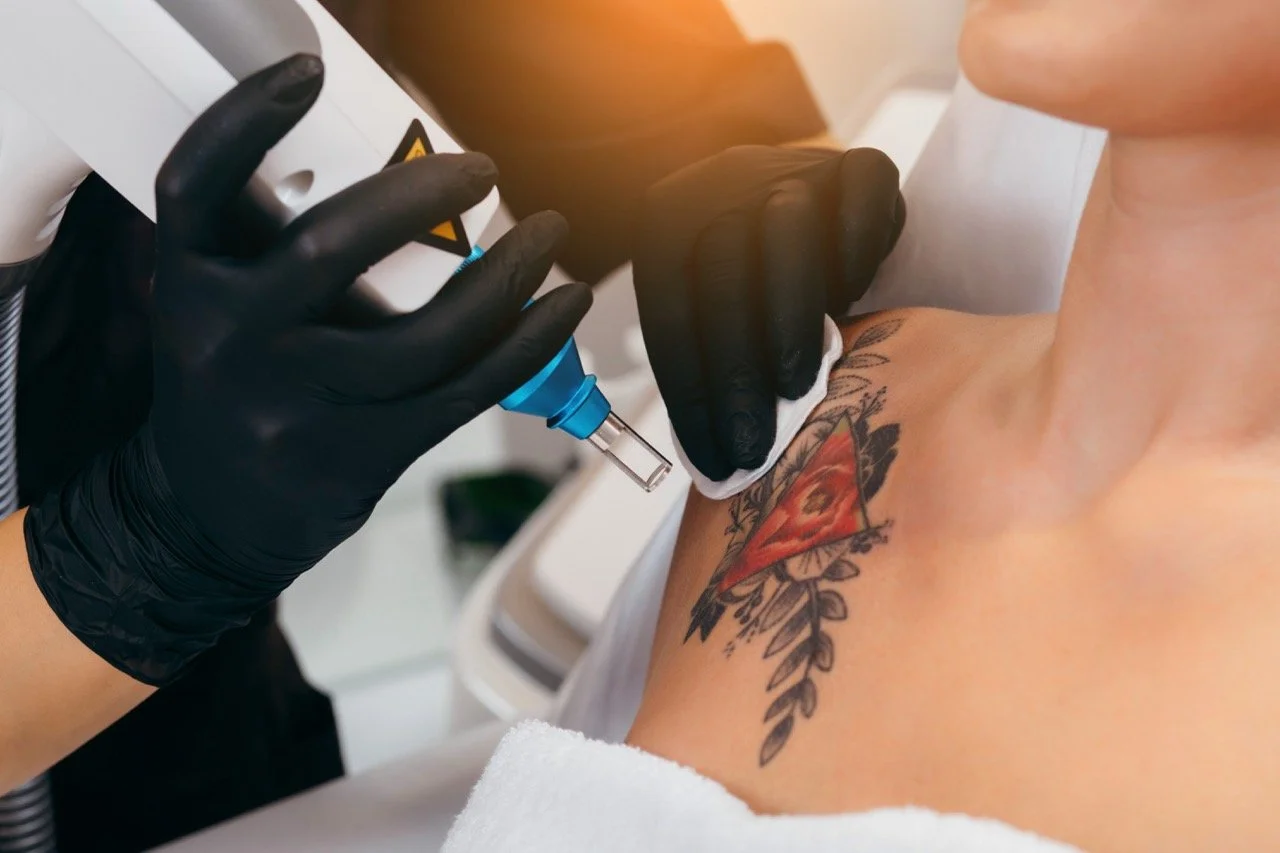 LASER TATTOO REMOVAL</span>