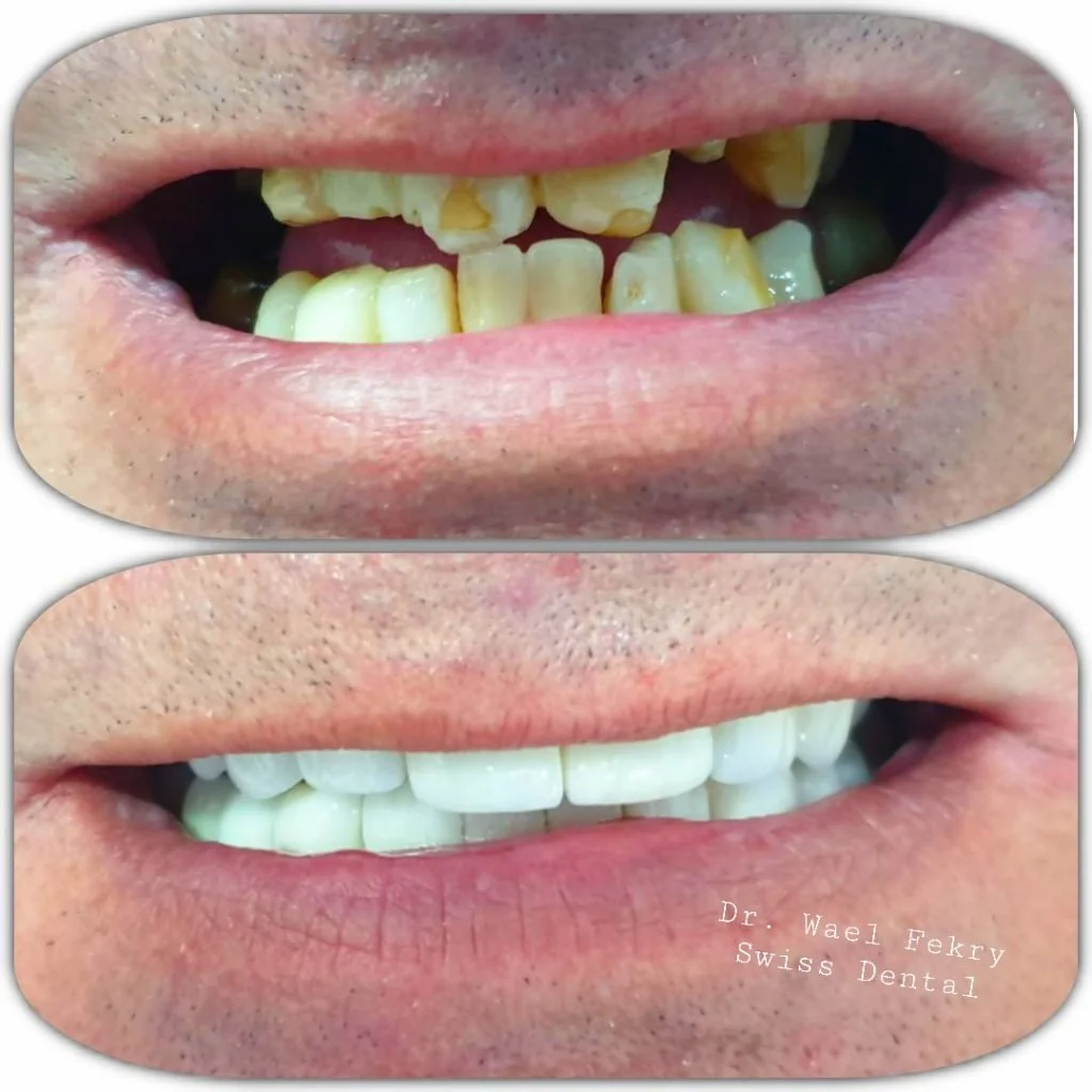 Before and after images of a person's teeth showing dental restoration, with the after photo displaying clean, white, and even teeth, from Dr. Wael Fekry Dental Clinic.