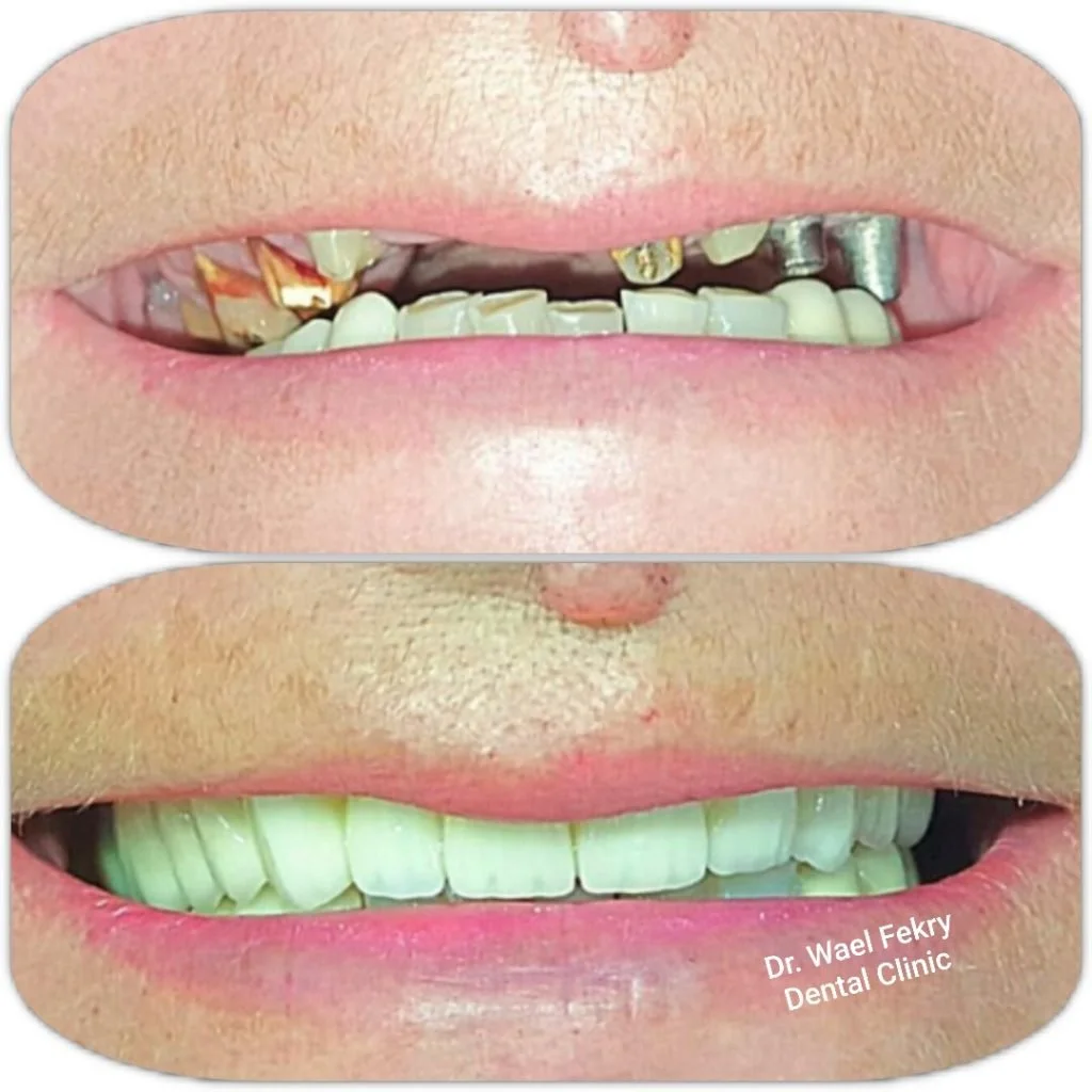 Comparison of teeth before and after dental restoration, showing improved appearance of teeth after treatment at Dr. Wael Fekry Dental Clinic.