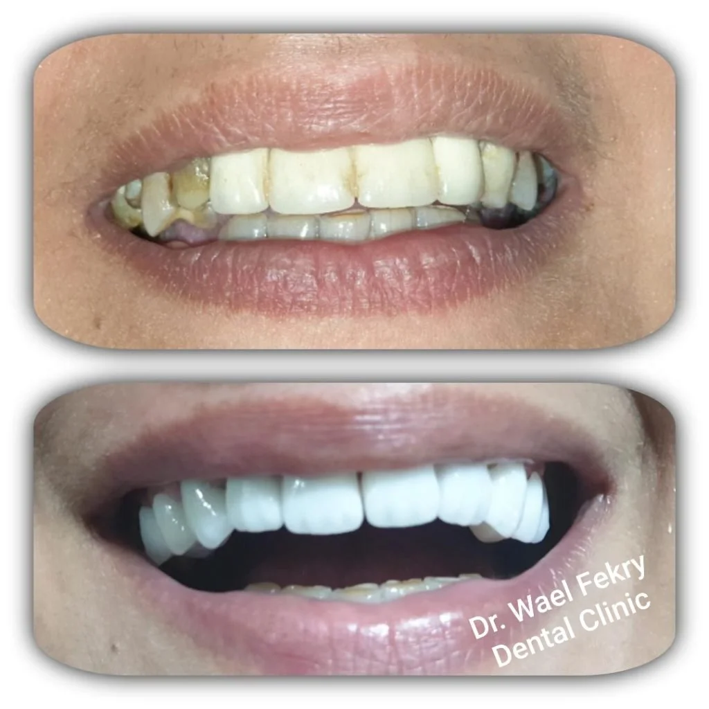 Comparison of teeth before and after dental treatment, showing improved appearance and whitening, with the after photo labeled 'Dr. Wael Fekry Dental Clinic'.