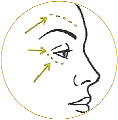 Diagram of a face showing three arrows and dots arround the eyes marked for lifting on the forehead, under the eye, and cheek area.