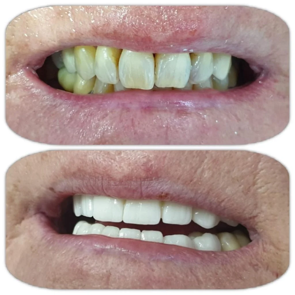 Comparison of teeth before and after dental treatment, showing significant whitening and alignment improvement, from Dr. Wael Fekry Dental Clinic.