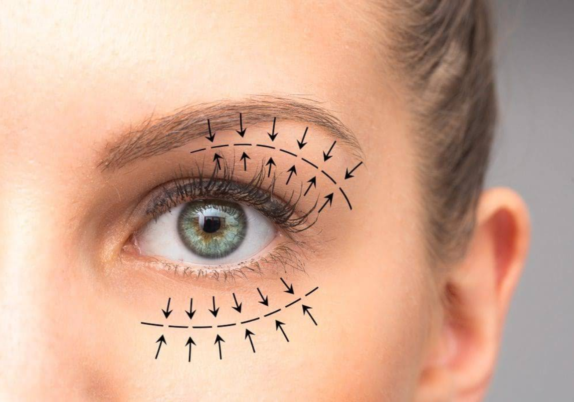 Close-up of a woman's eye with lines and arrows indicating eye lift or eyelid surgery areas.