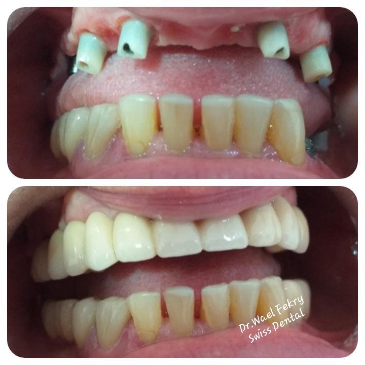 Before and after dental restoration showing significant improvement in teeth appearance with dental crowns or veneers, from Dr. Wael Fekry Dental Clinic.