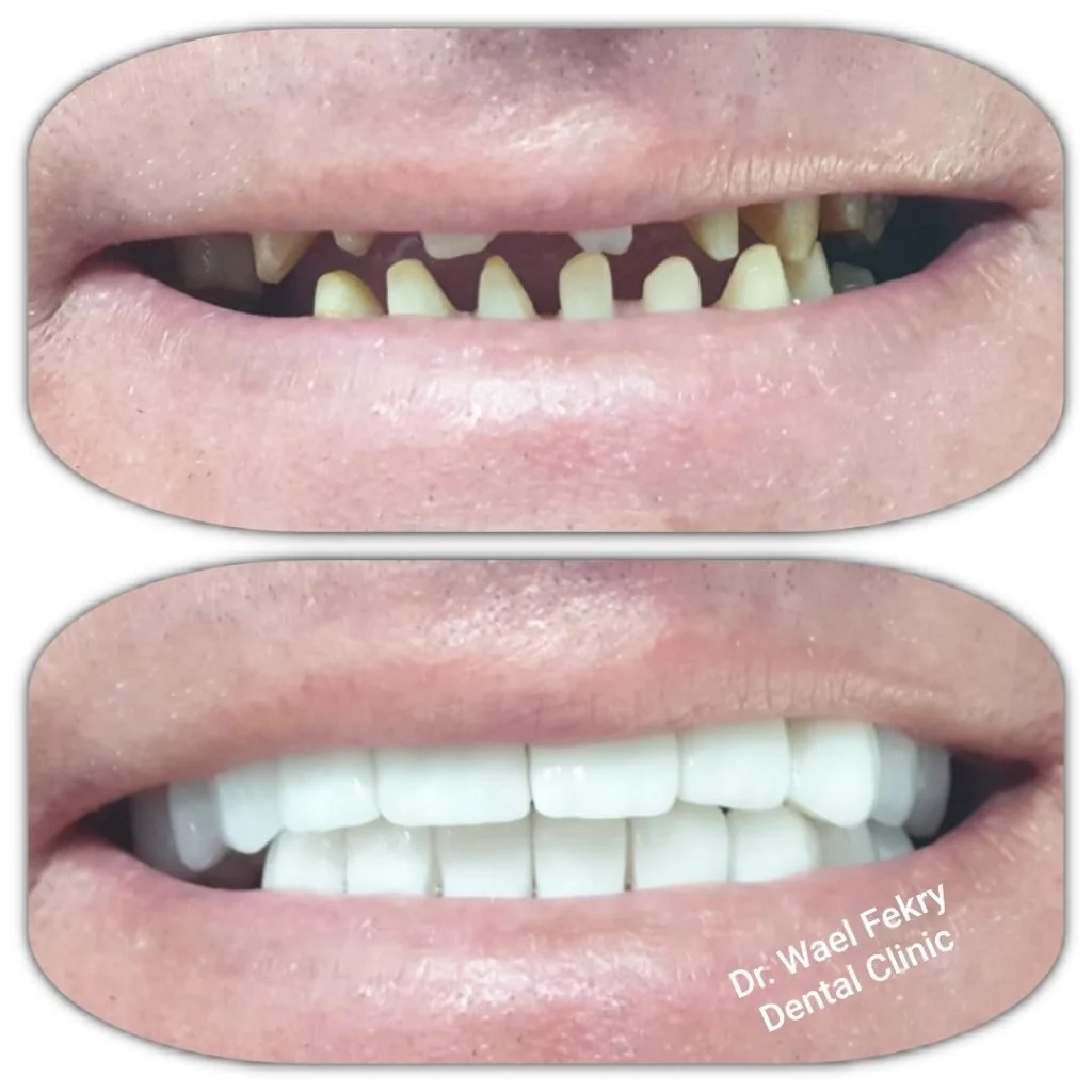 Comparison of a person's teeth before and after dental treatment, showing improved teeth appearance after dental work at Dr. Wael Fekry Dental Clinic.