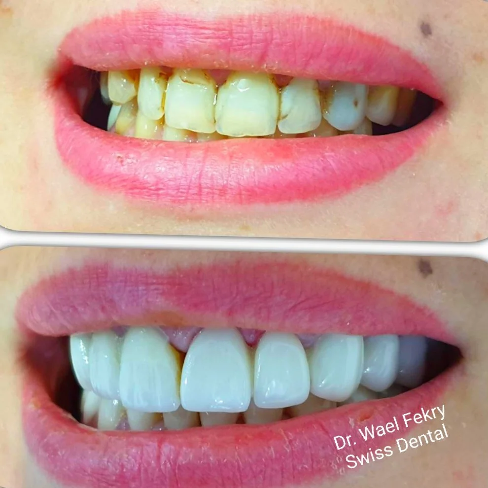 Close-up photos of a person's smile showing teeth before and after dental treatment, with the after photo featuring noticeably whiter and more aligned teeth, credit to Dr. Wael Fekry Dental Clinic.