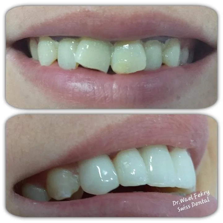 Before and after images of a person's teeth showing dental whitening and alignment improvement, with the after photo bearing the logo of Dr. Wael Fekry Swiss Dental.