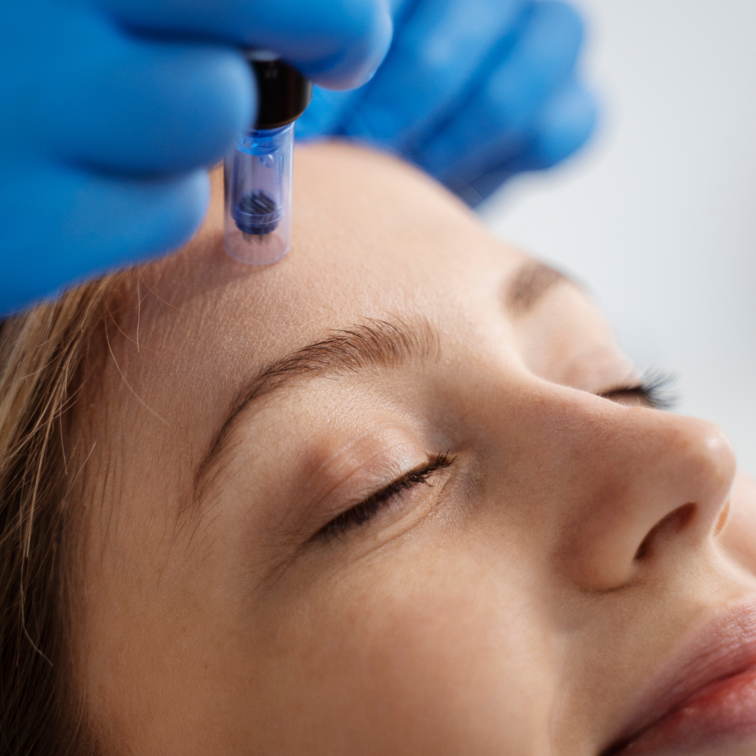 Medspa in Snohomish, WA 98290 l RF Microneedling Near Me