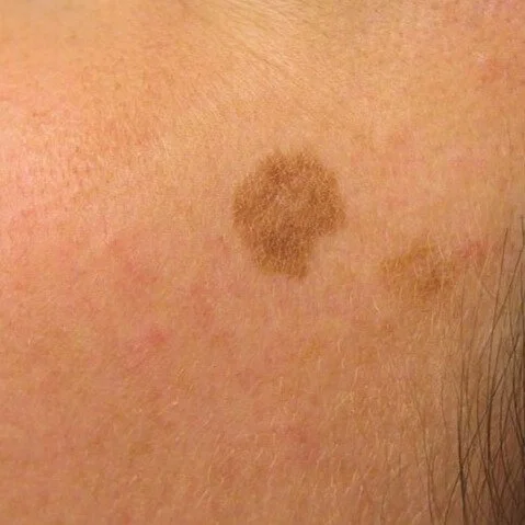 sun spot, solar lentigo