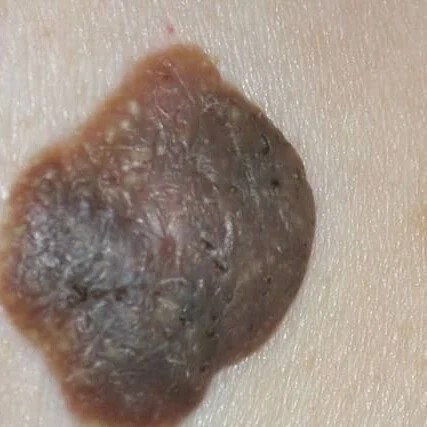 seborrheic keratosis