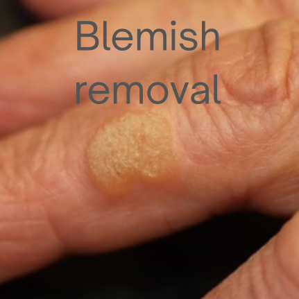 Skin Lesion & Blemish Removal