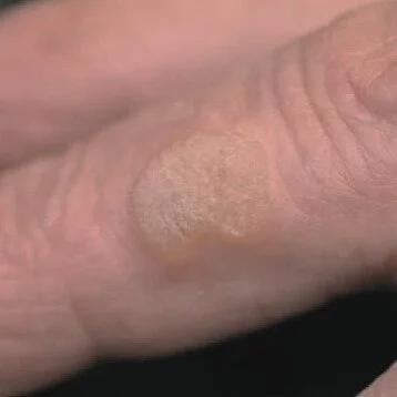 Skin Lesion & Blemish Removal