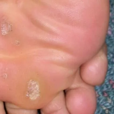 verruca plantar warts