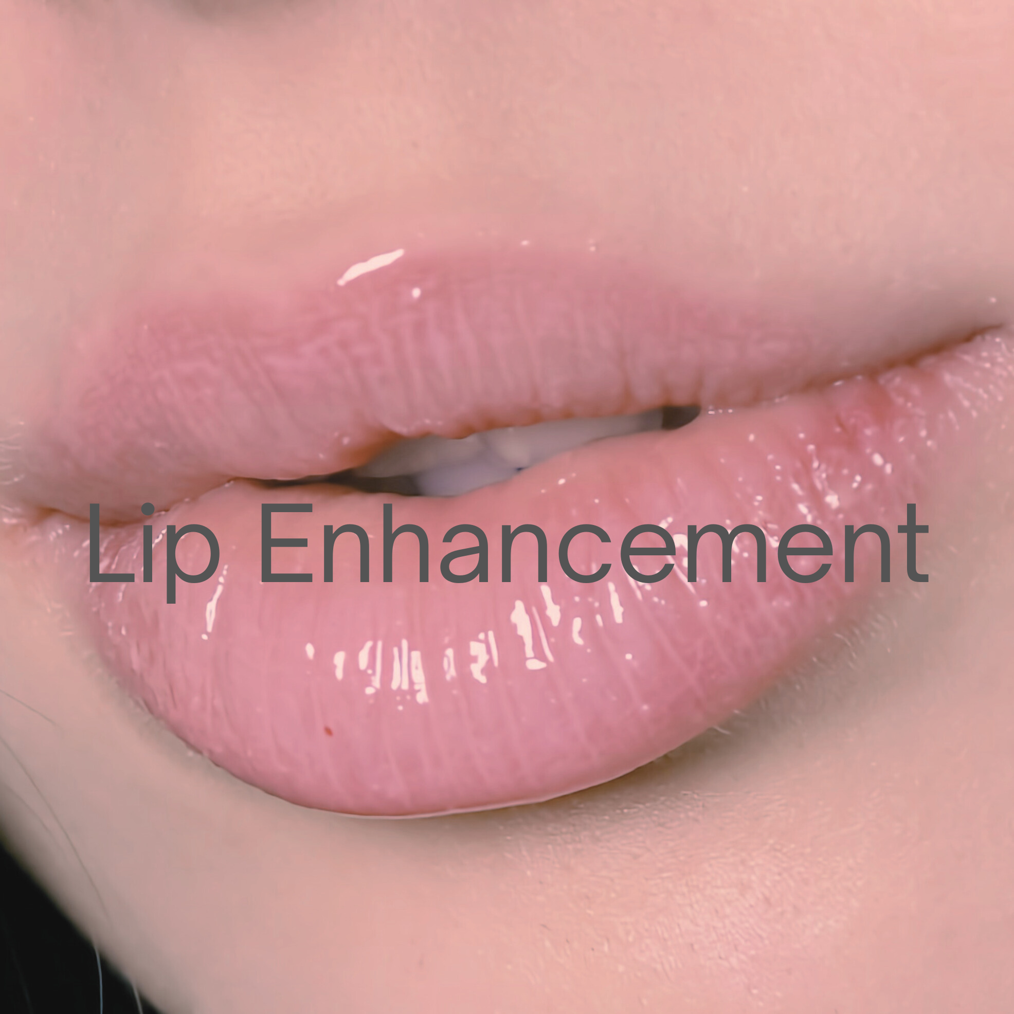 Lip Enhancement