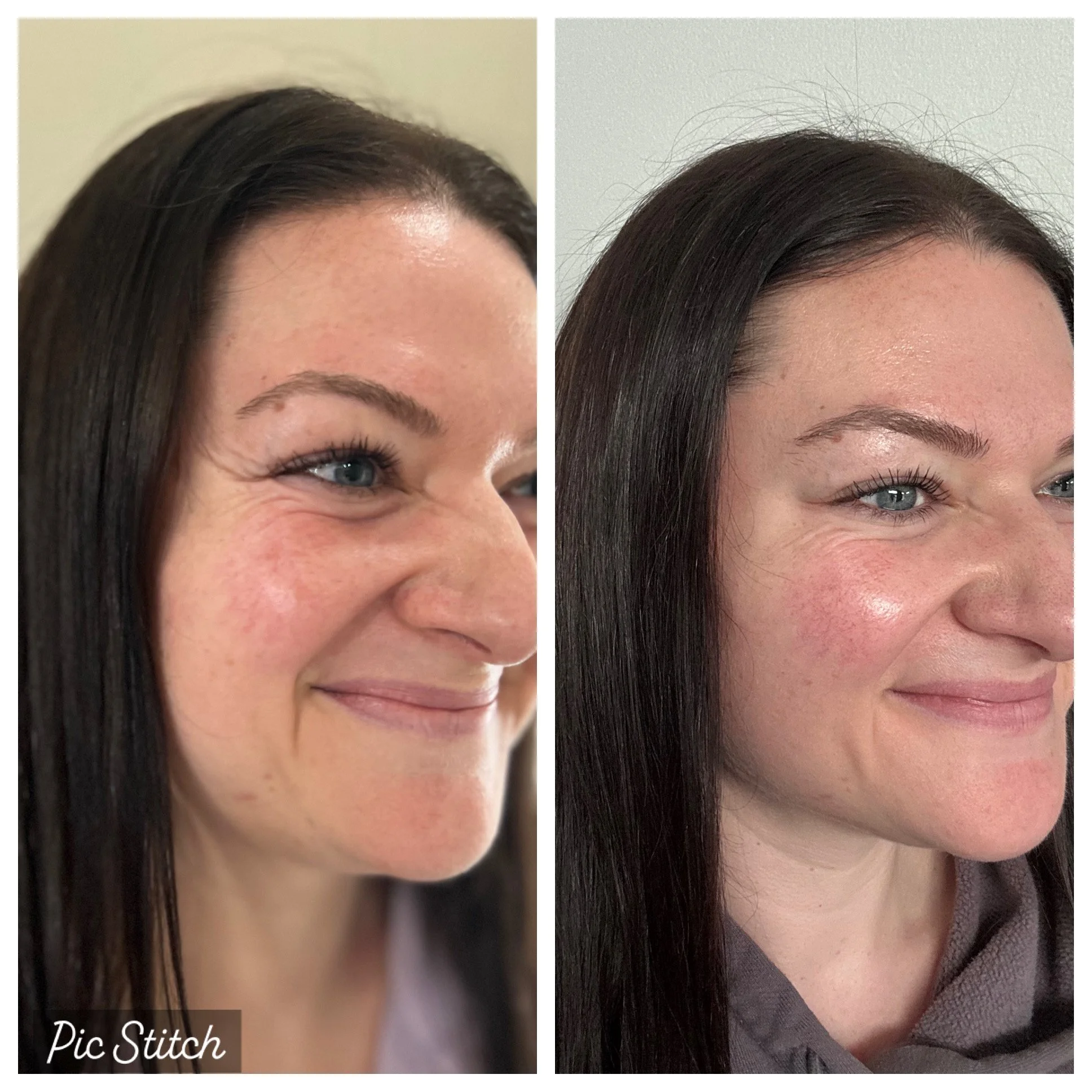 Side-by-side comparison of a woman's face before and after a cosmetic treatment, showing smoother and more even skin tone in the after photo.