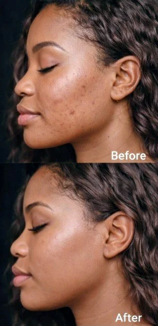 before and after  bad skin.jpg