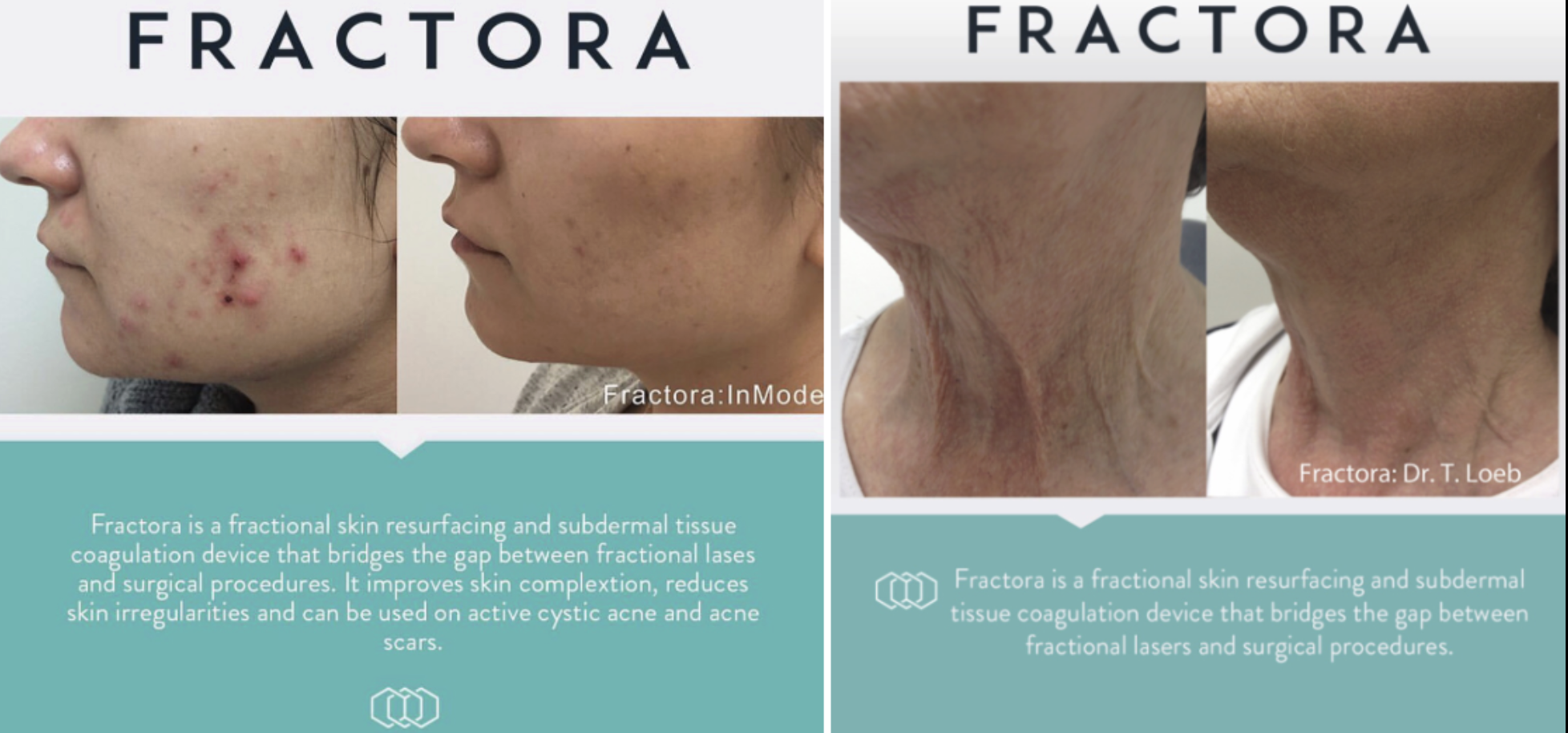 Fractora Skin Resurfacing in Vancouver: Advanced RF Microneedling at Imbodi Aesthetics