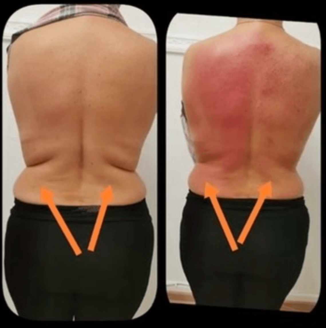 Comparison of a person's back before and after weight loss, highlighting reduction in fat around the waist and lower back.