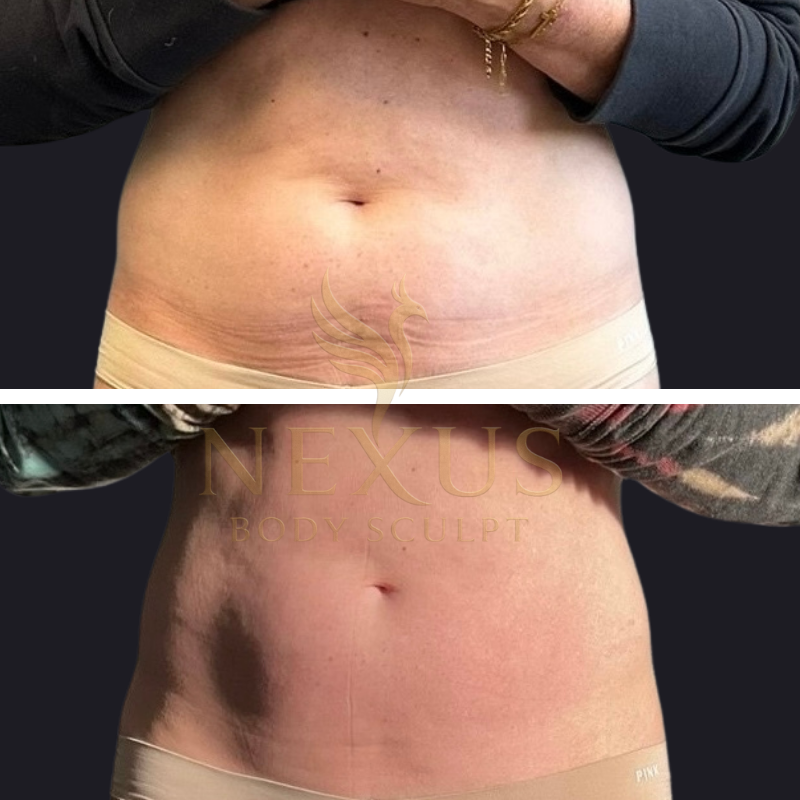 Before and after images of a person's abdomen showing body sculpting results, with a visible reduction in fat and improved skin tightening.