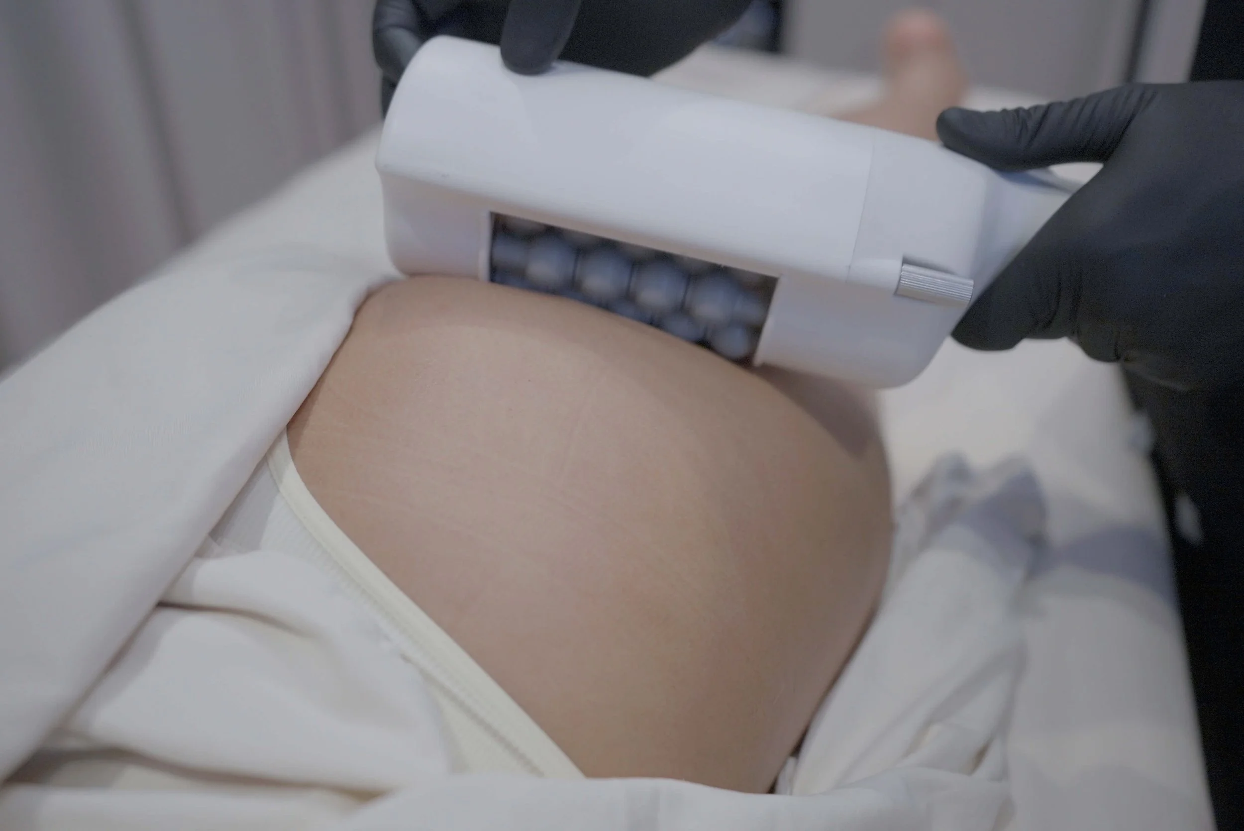 Person in black gloves holding a white device with a roller on their thigh, with a patient lying on a massage table.