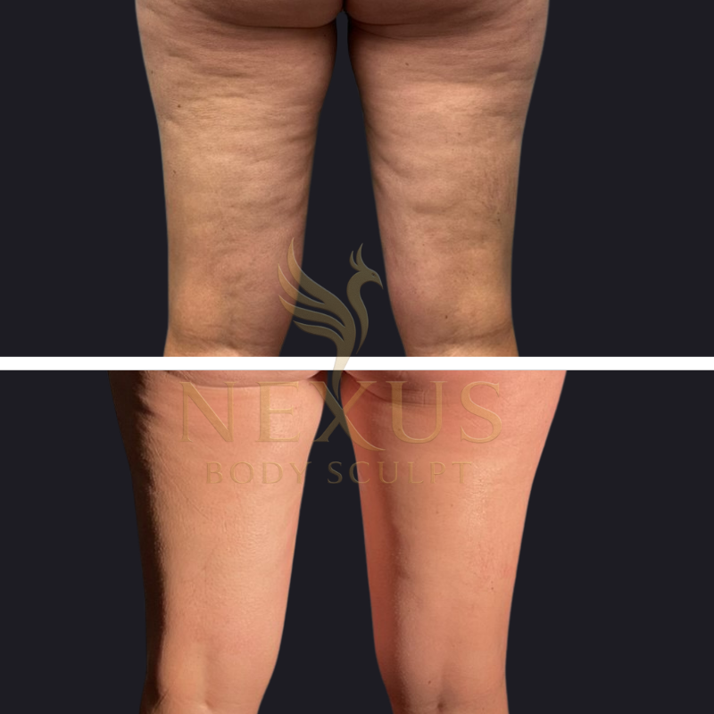 Comparison of the back of two legs, showing significant reduction in visible cellulite and smoother skin in the bottom image.