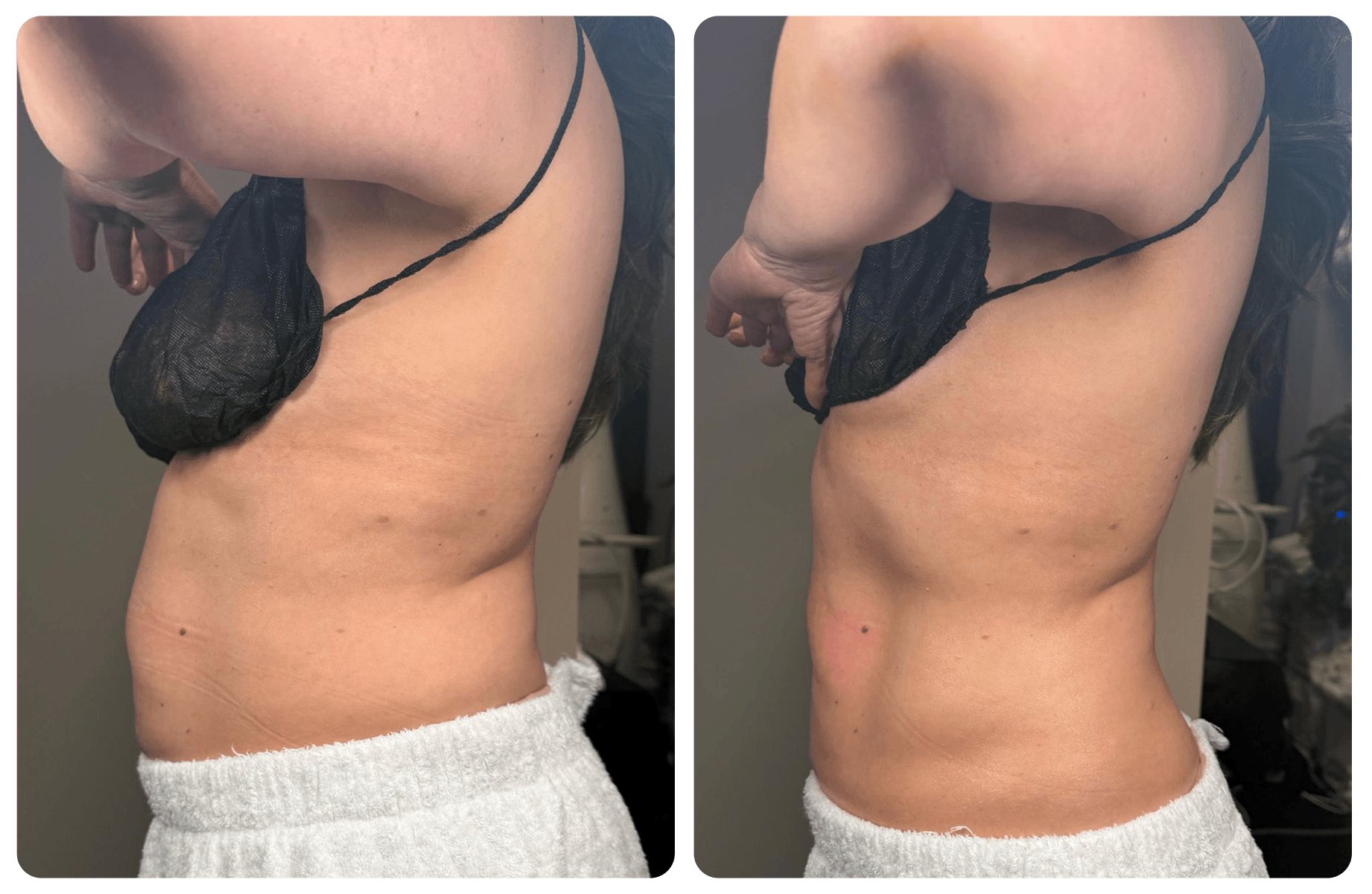 Side-by-side comparison of a person's torso, showing change in skin appearance, with the left side displaying a darker skin tone and the right side showing a lighter skin tone, both wearing black mesh lingerie and white towels around the waist.