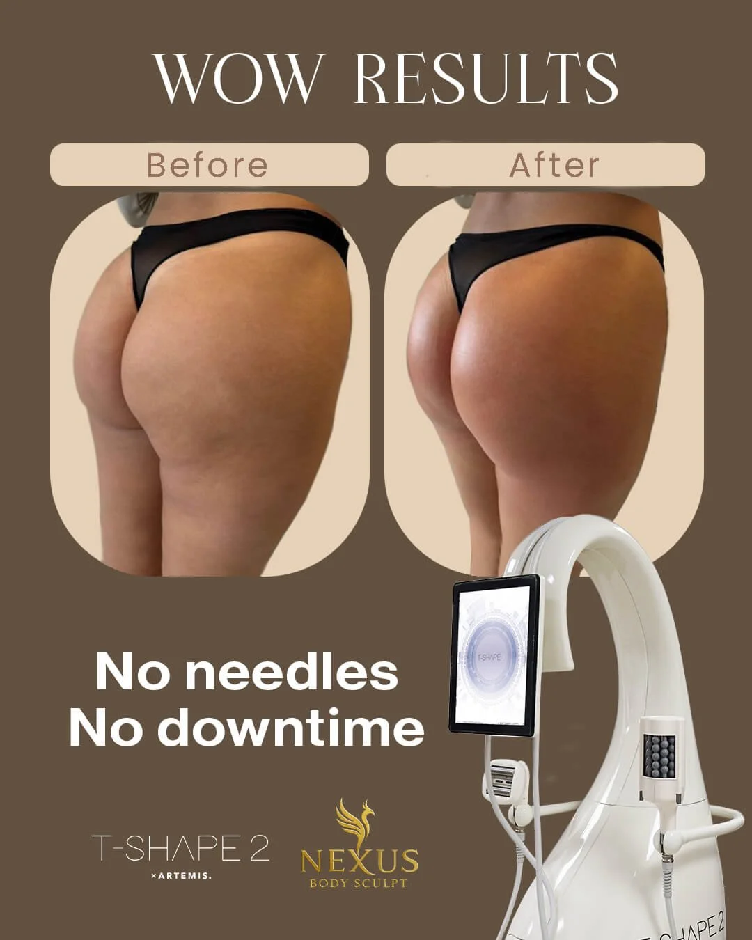 Before and after images of a woman's buttocks showing a reduction in size and improved contour, with a body sculpting device in the foreground. Text indicates results achieved without needles or downtime, promoting the T-SHAPE2 body sculpting treatment by NEXUS.