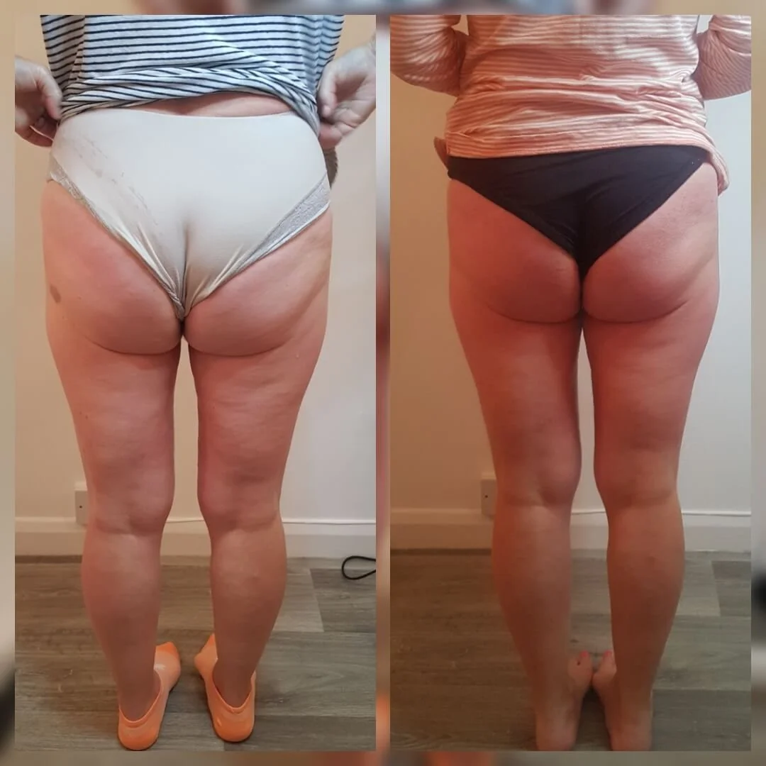 Comparison of a woman's back showing changes in skin texture and fat distribution between two photos, one wearing beige underwear and the other wearing black underwear.